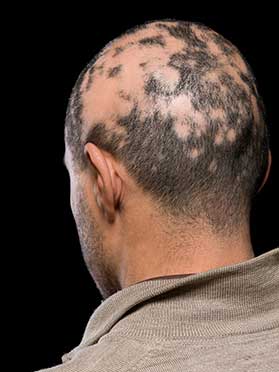 Alopecia Treatment in Clifton, NJ